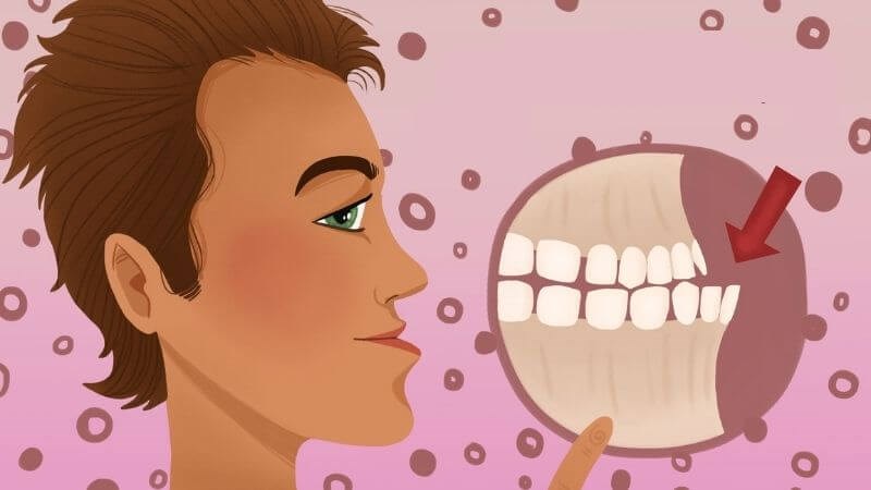 Lệch khớp cắn là hiện tượng hai hàm răng không thể cắn chặt lại với nhau