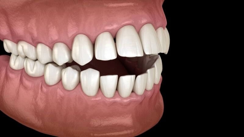 Khoảng cách giữa hai hàm xa nhau là dấu hiệu điển hình của bệnh