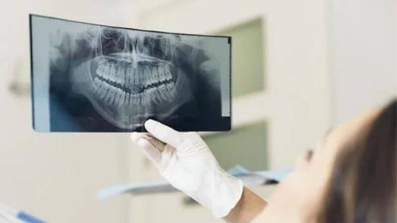 Chụp X-quang xương hàm có thể giúp bác sĩ chẩn đoán lệch khớp cắn