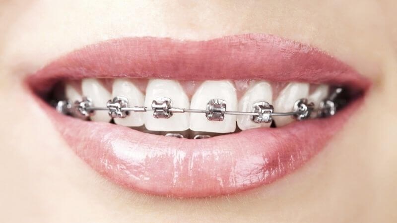 Niềng răng là một biện pháp điều trị lệch khớp cắn hiệu quả