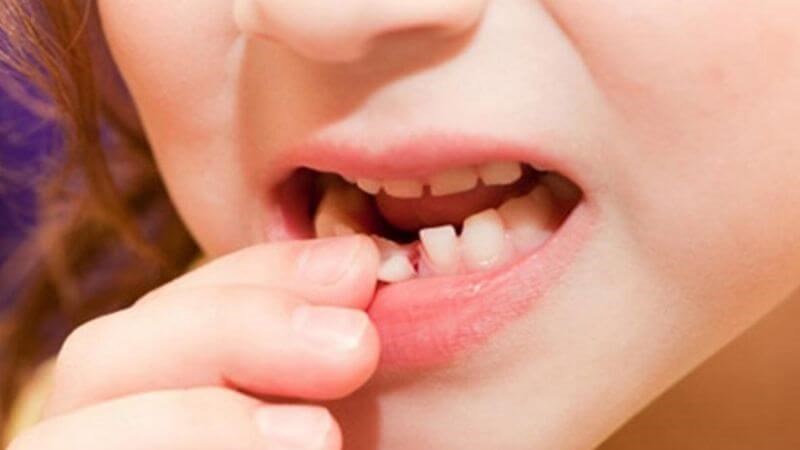 Nhổ răng sữa đúng cách có thể giúp hạn chế bệnh lệch khớp cắn