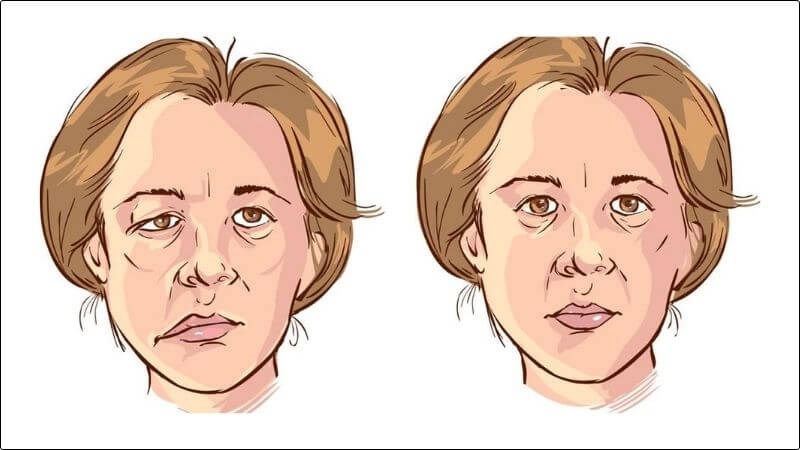 Người bình thường (trái) và người bị liệt dây thần kinh số 7 (phải) Người bình thường (trái) và người bị liệt dây thần kinh số 7 (phải)