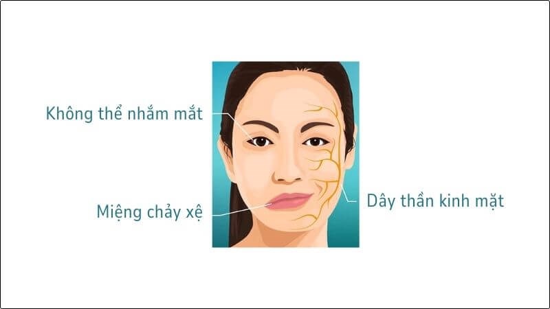 Biểu hiện liệt dây thần kinh số 7 Biểu hiện liệt dây thần kinh số 7