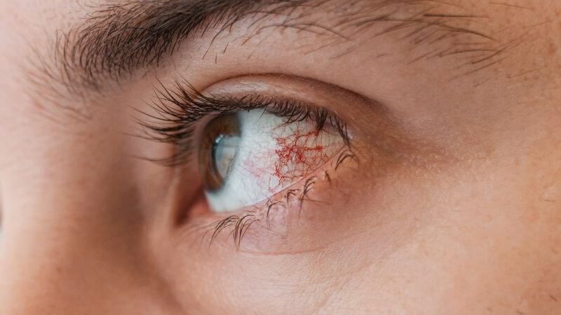 Bệnh nhân có thể bị biến chứng về mắt Bệnh nhân có thể bị biến chứng về mắt