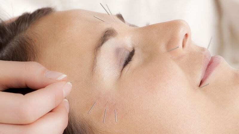 Châm cứu hỗ trợ điều trị bệnh Châm cứu là một biện pháp điều trị bệnh