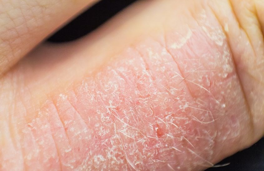 Bệnh chàm là vấn đề thường gặp ở trẻ sơ sinh Bệnh chàm là vấn đề thường gặp ở trẻ sơ sinh