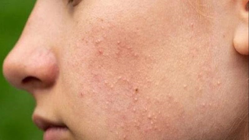 Mụn ẩn tồn tại dưới da nhưng cũng có thể tự lành sau vài tuần hoặc vài tháng