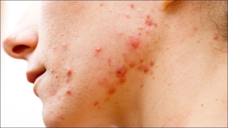 Nhiệm trùng da là biến chứng phổ biến nhất của mụn nhọt