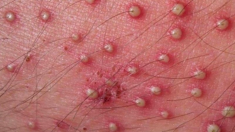 Viêm nang lông có thể dẫn đến nổi mụn ở tinh hoàn Viêm nang lông có thể dẫn đến nổi mụn ở tinh hoàn