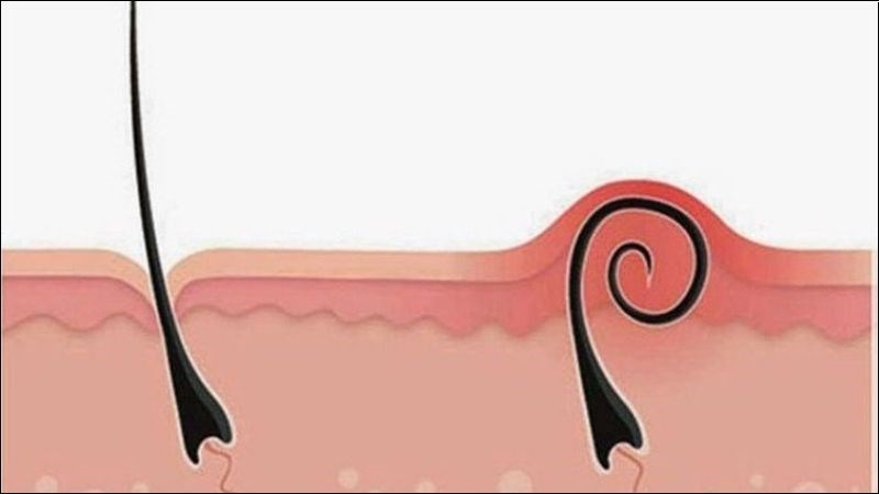 Lông mọc ngược là nguyên nhân thường gây mụn tinh hoàn Lông mọc ngược là nguyên nhân thường gây mụn tinh hoàn