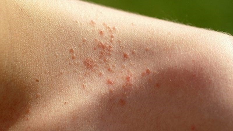 Bệnh phát ban nhiệt thường xuất hiện dưới dạng những đốm nhỏ màu đỏ Bệnh phát ban nhiệt thường xuất hiện dưới dạng những đốm nhỏ màu đỏ