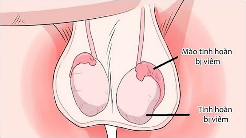 Mụn ở tinh hoàn là một trong những triệu chứng thường gặp của bệnh viêm tinh hoàn Mụn ở tinh hoàn là một trong những triệu chứng thường gặp của bệnh viêm tinh hoàn