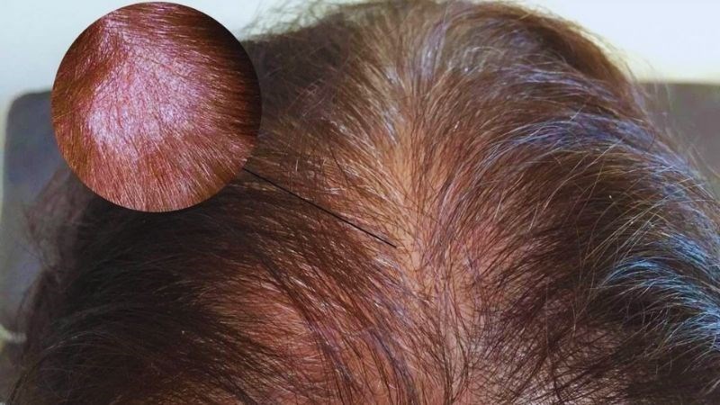 Người mắc nấm da đầu xuất hiện nhiều gàu