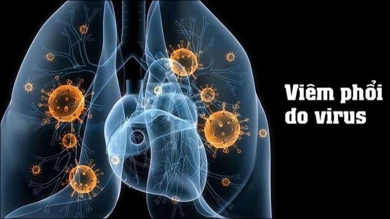 Vi rút có thể là tác nhân dẫn đến tình trạng viêm phổi nặng, chiếm đến 10% số ca bệnh