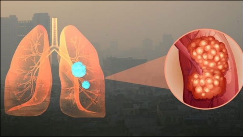 Môi trường bị ô nhiễm cũng là một nguyên nhân dẫn đến bệnh viêm phổi