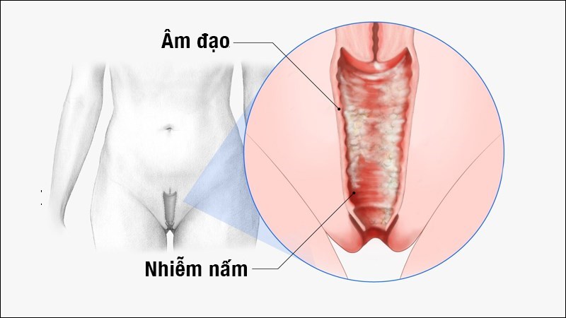 Ngứa Âm Đạo Là Bệnh Gì? Cách Điều Trị Hiệu Quả Và Phòng Ngừa Đúng Cách