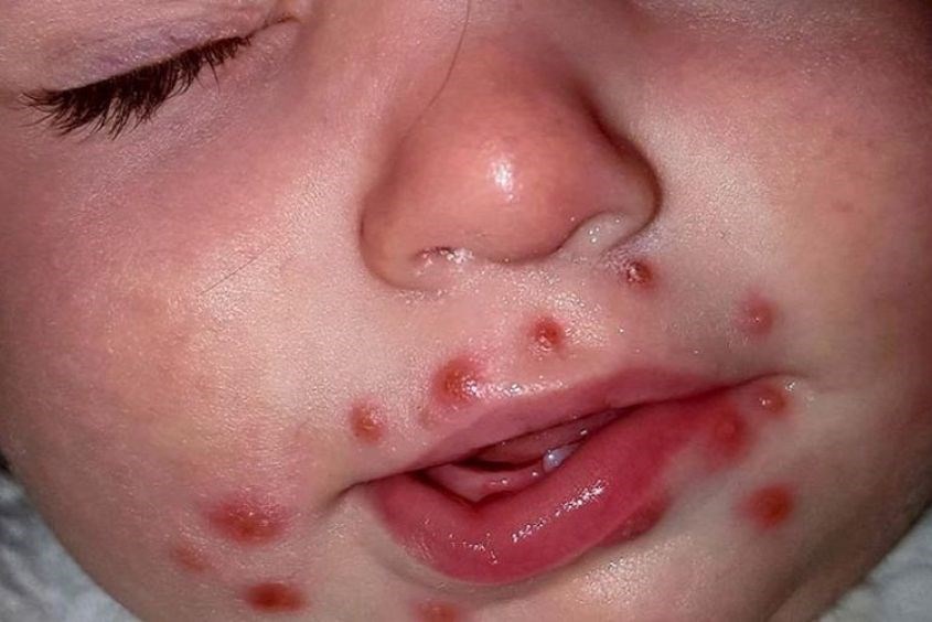 Nguồn lây bệnh tay chân miệng