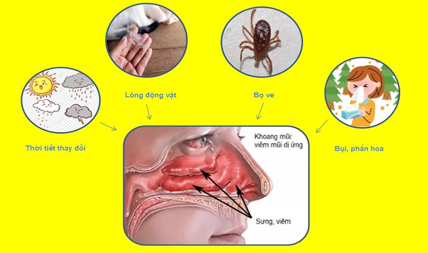 Viêm xoang mũi xuất tiết là gì?