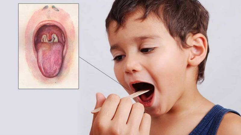 Trẻ em là đối tượng dễ mắc bệnh bạch hầu