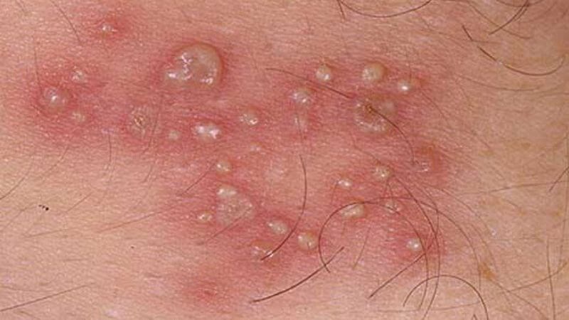 Người bệnh có thể bị nhiễm trùng tiết niệu sau nhiễm herpes sinh dục