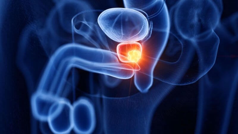 Nhiễm trùng roi Trichomonas có thể làm tăng nguy khả năng mắc ung thư tuyến tiền liệt