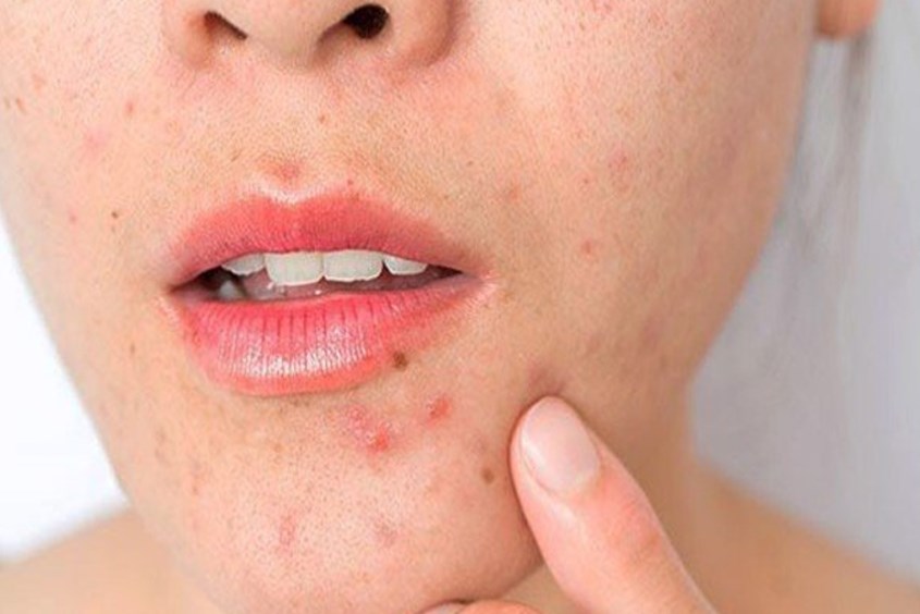 mẹ sau sinh ăn mì tôm có thể bị nóng trong, nổi mụn