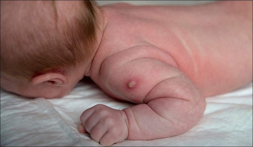 Những phản ứng sau khi tiêm phòng lao cho trẻ sơ sinh