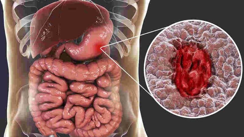 Nôn ra máu là bị bệnh gì? Nguyên nhân, triệu chứng và cách phòng ngừa hiệu quả