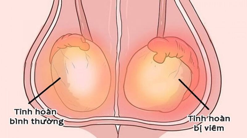 Viêm tinh hoàn do quai bị là một biến chứng nguy hiểm của bệnh quai bị