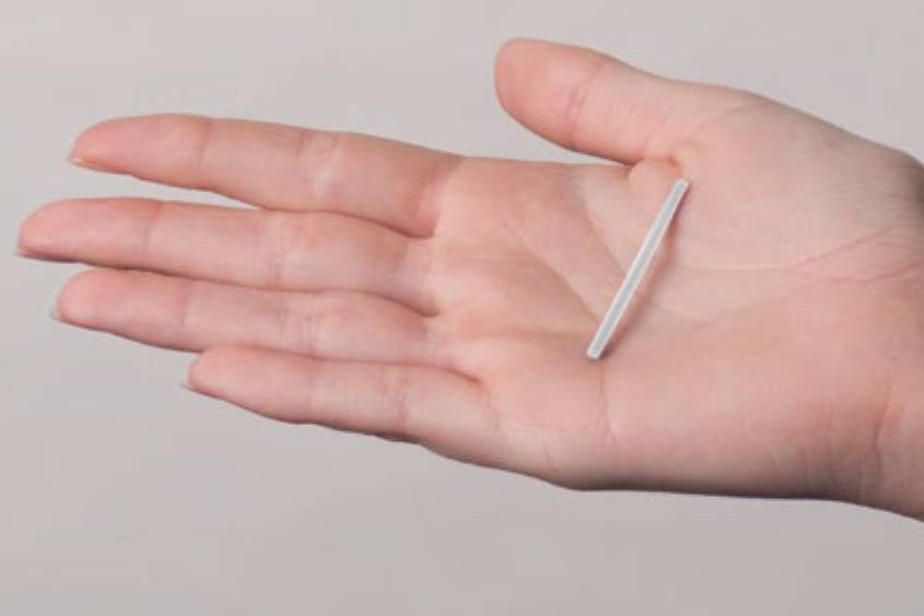 Que cấy tránh thai là gì?