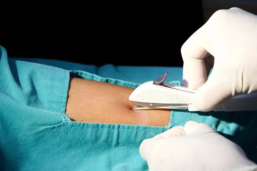 Lợi ích của que cấy tránh thai