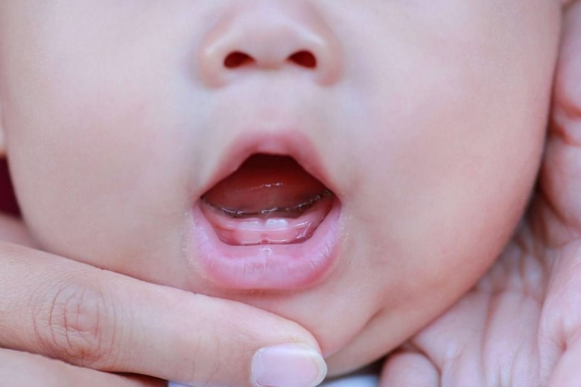 Răng sữa mọc lệch để lại hậu quả gì cho bé?