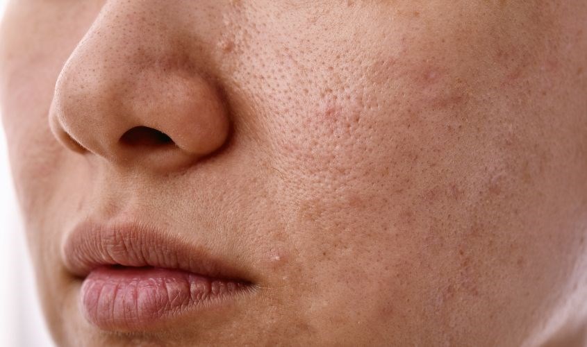 Không có khả năng loại bỏ mụn đầu đen