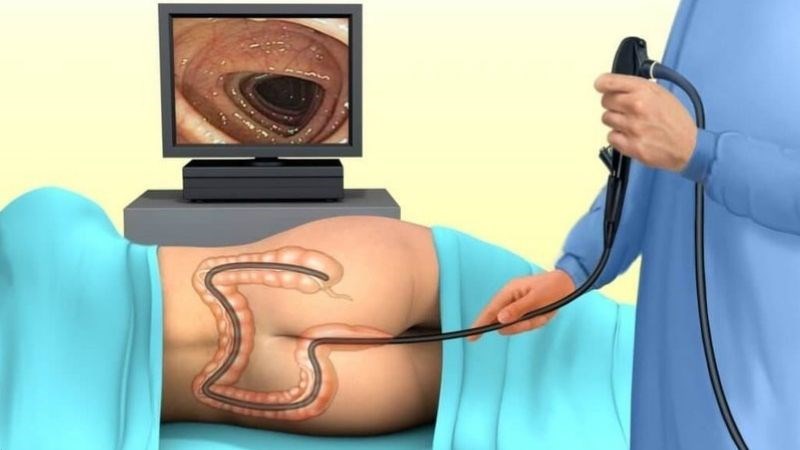 Nội soi trực tràng sigma giúp chẩn đoán các vấn đề về đường ruột
