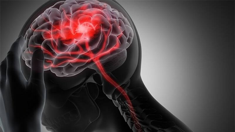 Tai biến biến mạch máu não có thể dẫn đến rối loạn ngôn ngữ Tai biến biến mạch máu não có thể dẫn đến rối loạn ngôn ngữ