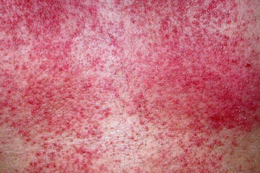 Rôm sảy ở trẻ sơ sinh