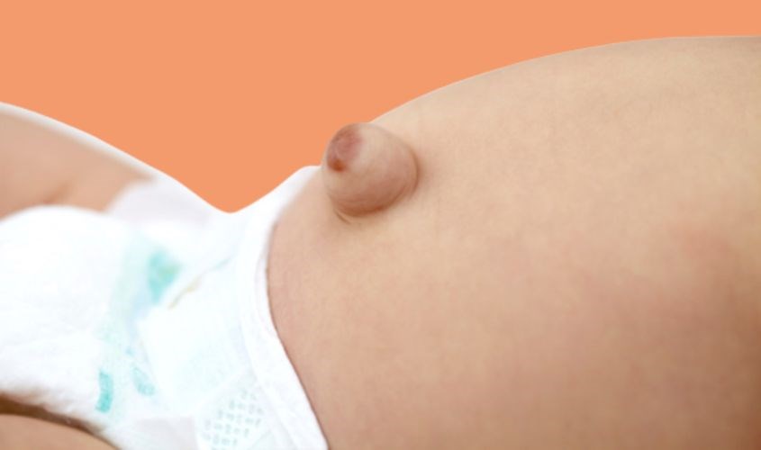 Hình dáng khi rốn trẻ sơ sinh bị lồi. Nguồn: vinmec.com