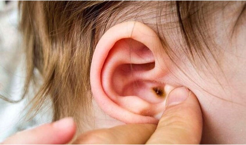 Nước vào tai nếu không xử lý kịp thời và đúng cách có thể dẫn đến viêm tai giữa