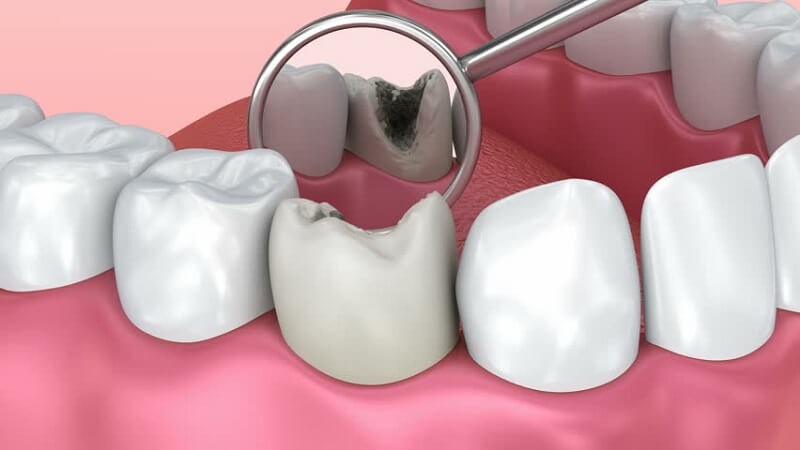Có 3 loại sâu răng phổ biến