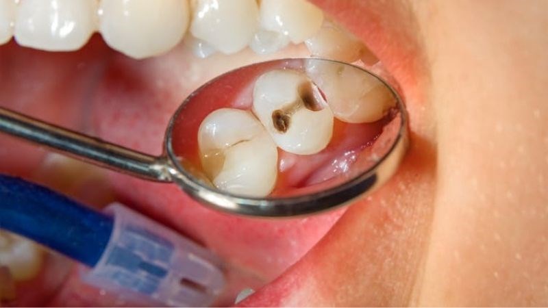 Các dấu hiệu của sâu răng tùy thuộc vào mức độ và vị trí sẽ khác nhau