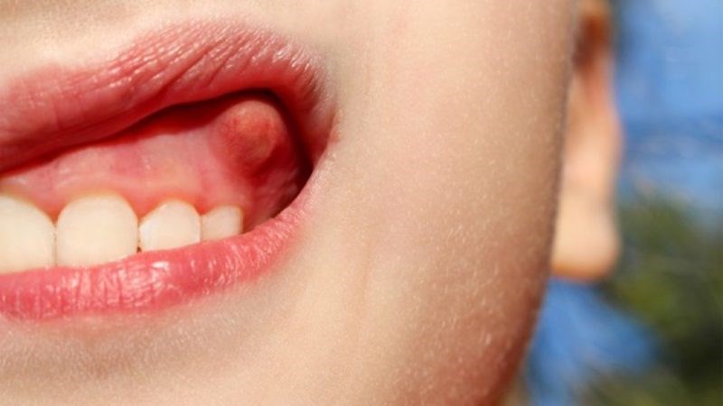 Áp xe răng là một trong những biếm chứng nghiêm trọng của sâu răng