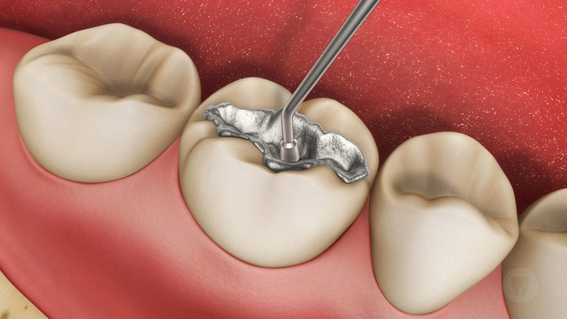 Trám răng là lựa chọn điều trị chính khi sâu răng