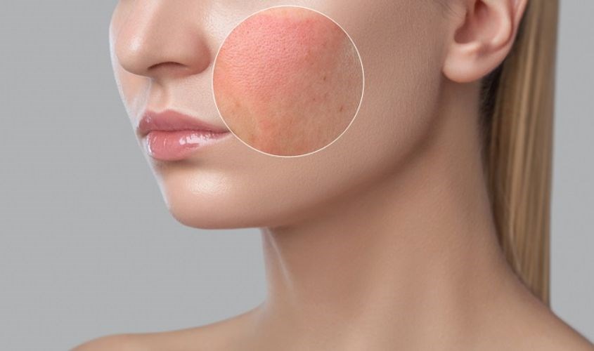 Dễ gây kích ứng cho da nhạy cảm nhất vì có chứa hương liệu