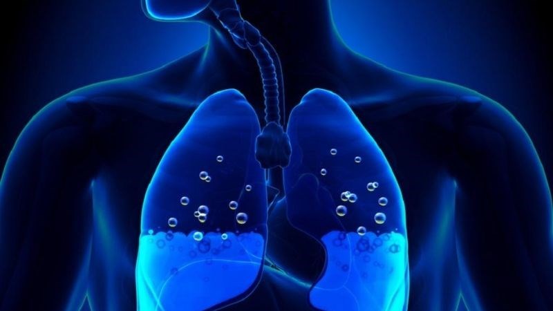 Phù phổi khi bị sốt rét có thể dẫn đến suy hô hấp Phù phổi khi bị sốt rét có thể dẫn đến suy hô hấp