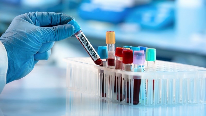 Bác sĩ có thể thực hiện xét nghiệm máu để chẩn đoán sốt rét Bác sĩ có thể thực hiện xét nghiệm máu để chẩn đoán sốt rét