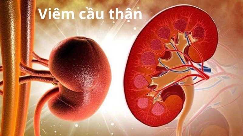 Bệnh cầu thận làm xơ hóa và biến đổi cầu thận khiến thận thực hiện chức năng kém