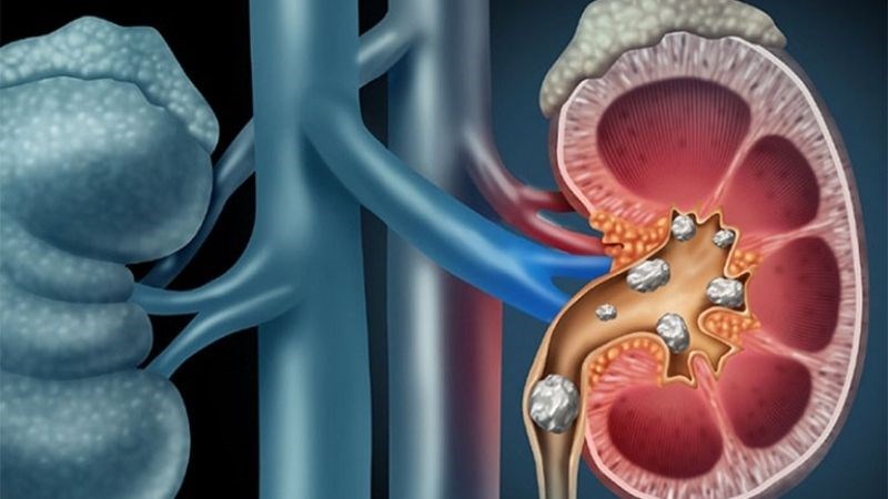 Sỏi tiết niệu có thể ngăn cản nước tiểu thải ra ngoài gây ứ nước thận