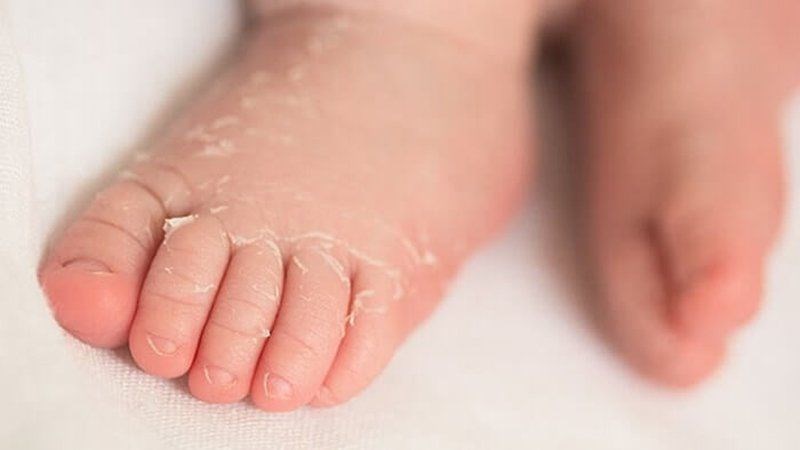 Aspirin có tác dụng điều trị hội chứng Kawasaki. Aspirin có tác dụng điều trị hội chứng Kawasaki.