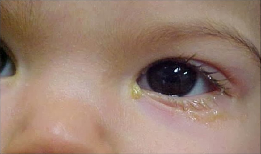 tắt tuyến lệ ở trẻ em