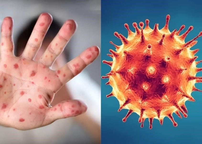 Tất tần tật về bệnh đậu mùa khỉ. Nguồn từ Hindustan News Hub